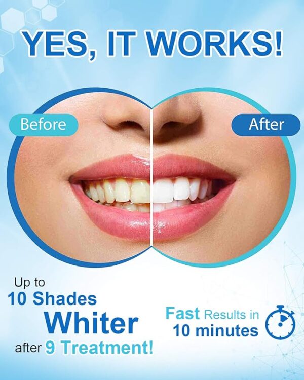 MySmile Non-Sensitive Teeth Whitening Pen Mint Gel Enamel Safety - Image 3